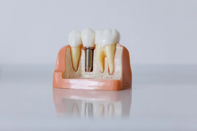Modello didattico in sezione di un impianto dentale tra due denti naturali.