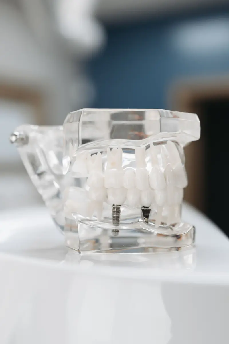 Modello trasparente di un'arcata con impianti dentali.